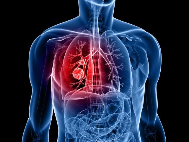 Osam simptoma raka pluæa koje ne smete da ignorišete